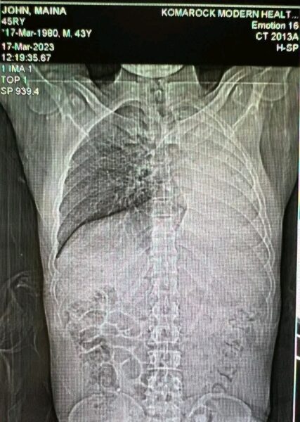 An X-ray image of MC Fullstop's lungs in 2023.PHOTO/Instagram/@mc_fullstop